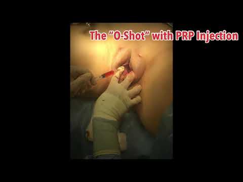 Labiaplasty Surgery with External Vaginal Tightening, “Labial Puff” & The O-Shot PRP Injection